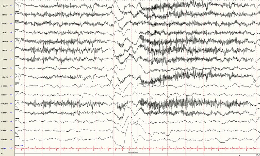 Ictal EEG Medium- to high-voltage,positive slow waves maximal at vertex regions with