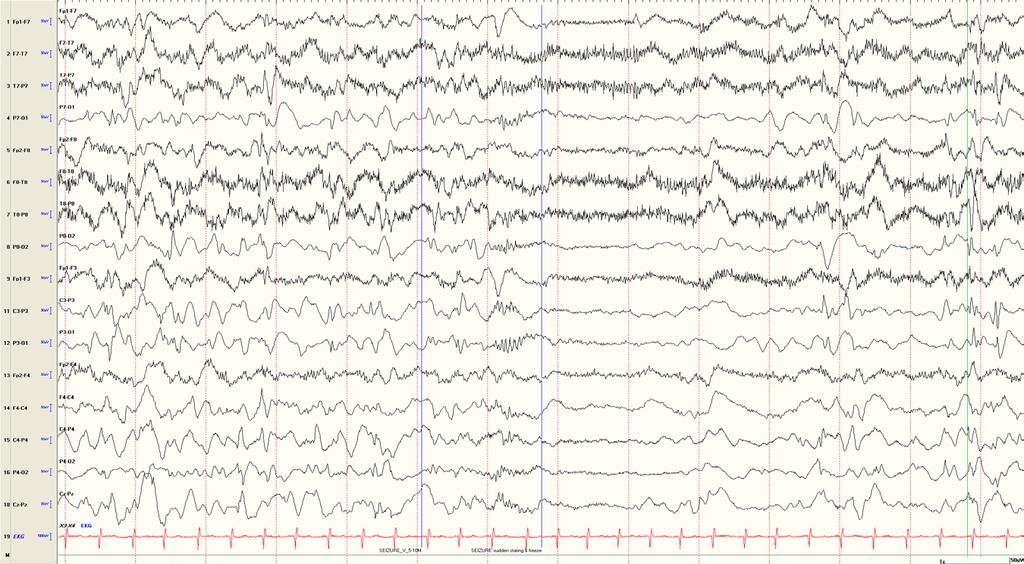 Ictal EEG