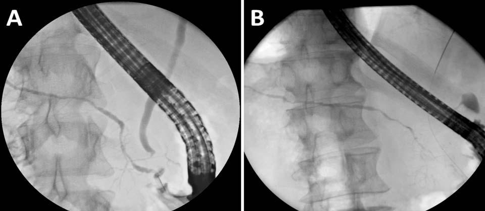 Imaging ductal Long (> 1/3 the length of the pancreatic duct) or multifocal strictures without upstream dilation (<5 mm) Side branches arising from a strictured segment MRCP is not reliable Role of