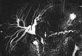 Magnetic resonance cholangiography in a patient with autoimmune cholangiopathy and autoimmune pancreatitis Zepeda Gómez, S.