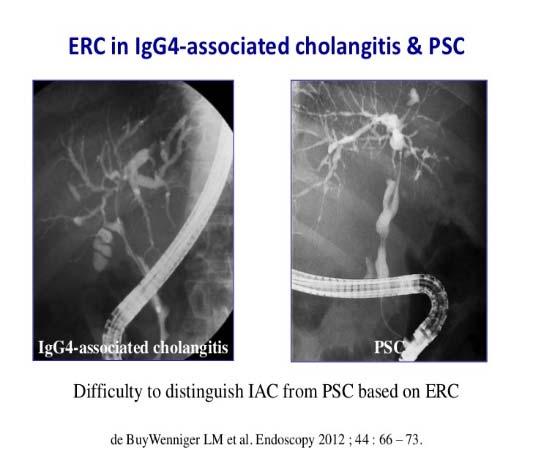 ERCP ERCP is superior to MRCP for demonstrating luminal changes in the bile duct More invasive than MR Risk of post ERCP pancreatitis IAC: Dilation after