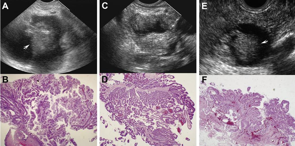 February 2012 MURAL NODULES IN PANCREATIC CYSTS 197 Figure 5. EUS features of mural nodules. EUS (A, C, E) and matching histology (B, D, F) from 3 cases.