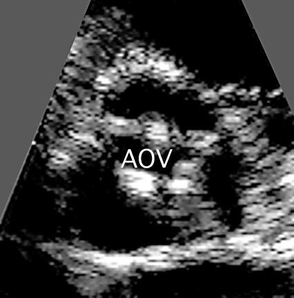 Planimetry of the Aortic Valve AVA = 1.