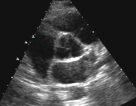 Normal AV orientation and opening Diastole Systole N R L Aortic Stenosis Etiology
