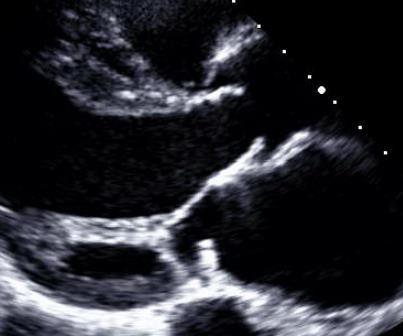 Bicuspid Aortic Valve Most common congenital anomaly (1-2%) Commissure may be horizontal