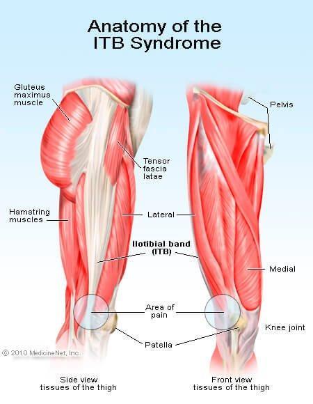 Iliotibial Band Syndrome (ITBS) or Iliotibial Band Friction Syndrome (ITBFS) Result of a tight or inflamed IT band Pain