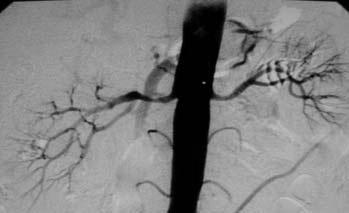 4) Discussion Renal artery stenosis impairs renal perfusion, leading to renal ischaemia, which in turn activates the renin angiotensin axis.