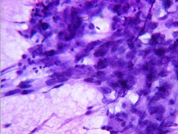 Fig 1 - FNAC Smear from the Left Supraclavicular Lymph Node - H&E (40x) - Pleomorphic Tumor Cells in Clusters, Singles and Acinar