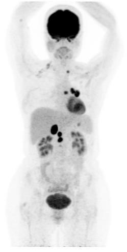 Patterns of 89 Zr-trastuzumab PET/CT confronted