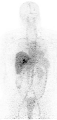 few (C) metastatic lesions are seen on the HER2