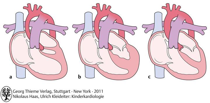 Typical forms: Mitral atresia/aortic atresia (MA/AoA) Mitral stenosis/aortic stenosis