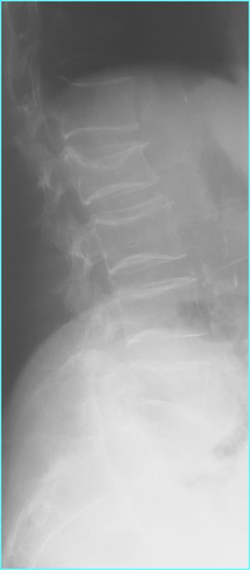 Fracture Risk Depends on the Dose of Glucocorticoids Relative risk of fracture 6 5 4 3 Hip Vertebral 2