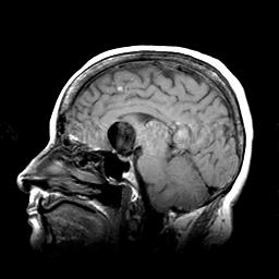 Our Patients sagittal MR (T1 sequence) T1 sequence Fat is bright (high signal) CSF is dark (low signal) Sagittal section corpus callosum midbrain
