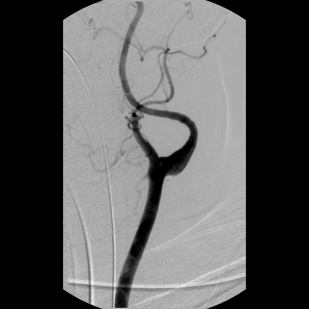 Our patient s Cerebral artery angiogram during embolization Femoral artery catheterization route to the internal carotid Inject contrast Continue moving
