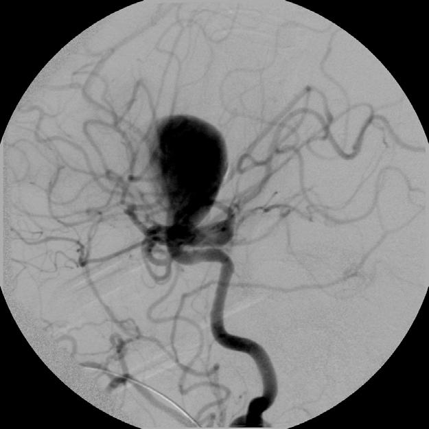 Our Patient s Cerebral artery angiogram during embolization Locate aneurysm Estimate volume Thread a microcatheter through the main catheter to the aneurysm site