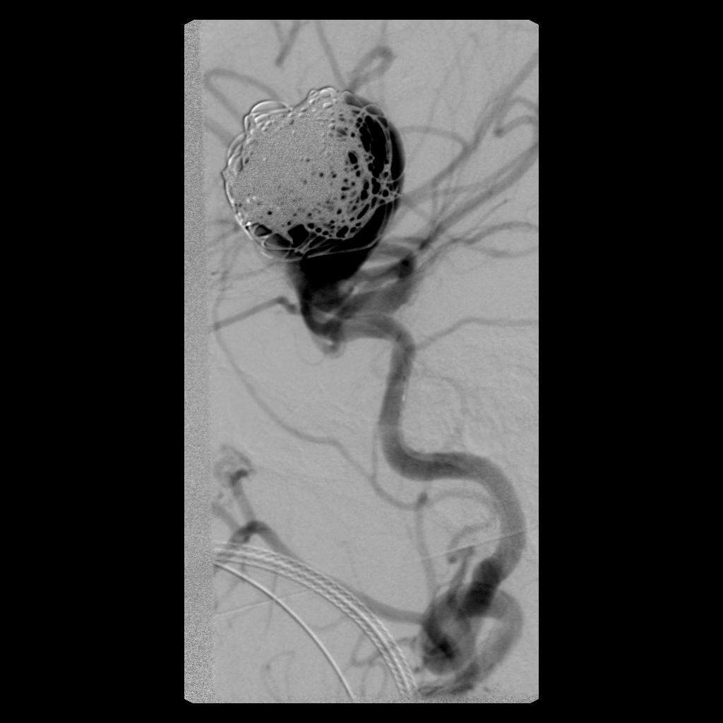 Our patients cerebral angiogram during embolization Internal
