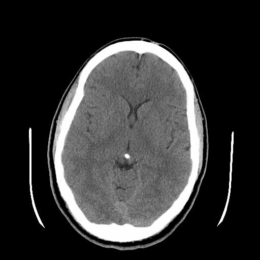 Normal Head CT Check: Blood, acute High attenuation (bright) Midline Is symmetry preserved?