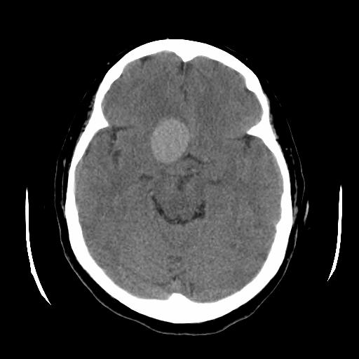 Our Patient s Head CT (no contrast) Film Findings: Spherical mass Smooth margined High attenuation Slight mass effect Located just