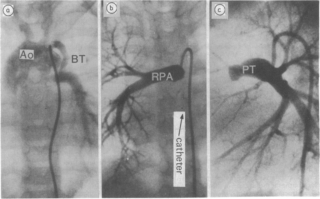 Obstruction of the central pulmonary artery after shunt operations in patients with pulmonary atresia Table 1 Intracardiac anatomy and previous operations in 56 patients with pulmonary atresia