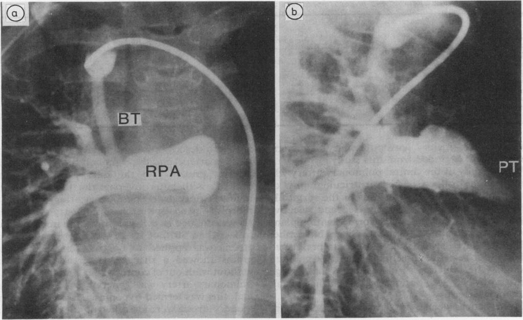 536 0L Momma, Takao, Imai, Kurosawa... Fig 2 Pulmonary arteriograms of a 10 year old girl with tetralogy of Fallot, pulmonary trunk atresia, ductus arteriosus, and a right modified Blalock shunt.
