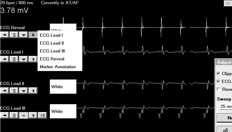 By default, the ECG window appears in partial view. You can expand this window to its full size by selecting the small square button in the upper-right corner of the window.