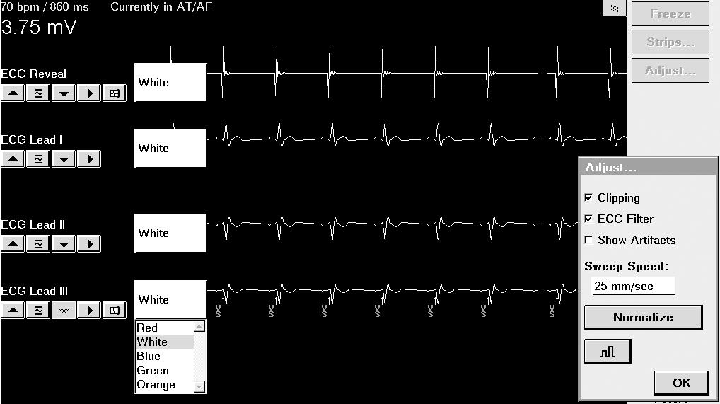 3 The down arrow decreases the size of the ECG. 4 Use the source button to choose which ECG to display. 5 The print selection button enables or disables the ECG for printing.