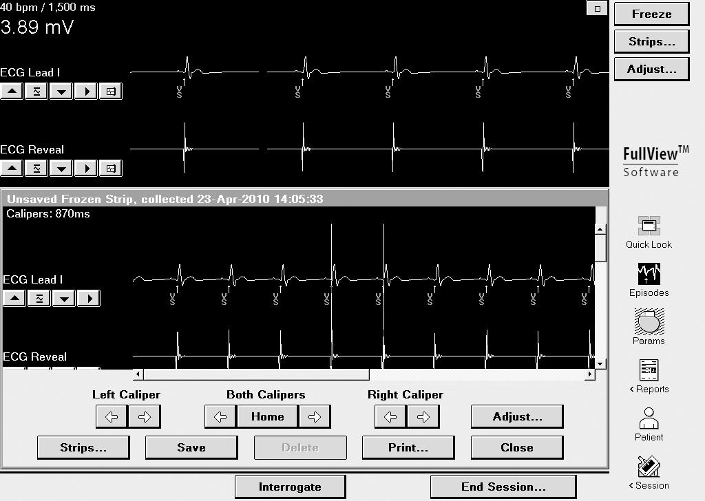 Figure 16. Interpreting the frozen strip viewing window 1 [Freeze] freezes a real-time ECG and displays it in the frozen strip viewing window.