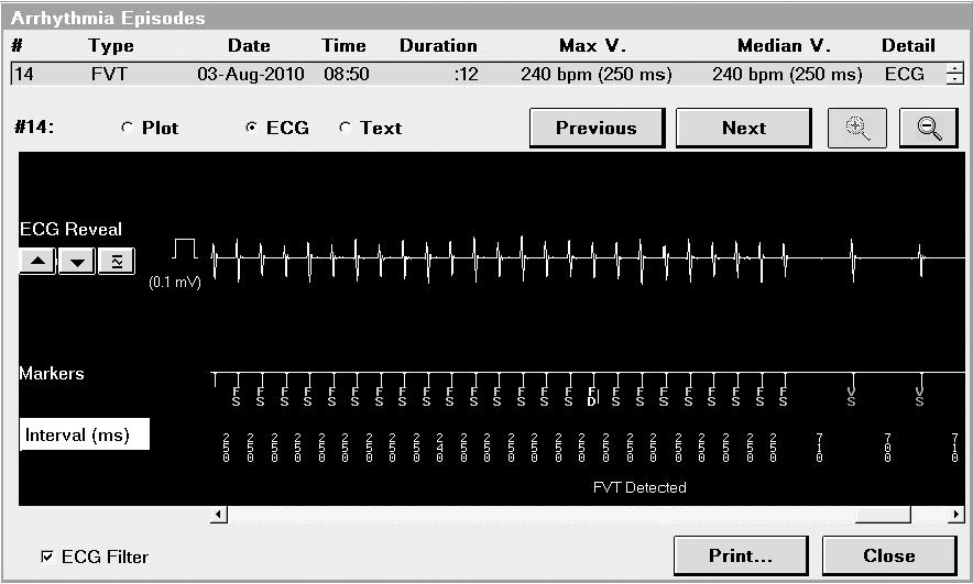 Figure 23. Episode ECG 1 The Marker Channel displays the annotated events. 2 The decision channel displays an annotation if an episode is detected.