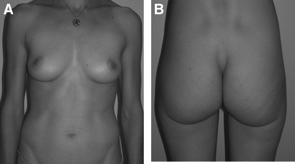 Annals of Plastic Surgery Volume 63, Number 3, September 2009 Simultaneous Bilateral IGAP Breast Reconstruction closed in 3 layers and a suction drain is placed.