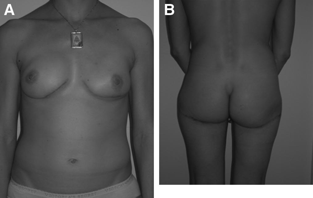 Levine et al Annals of Plastic Surgery Volume 63, Number 3, September 2009 The patients rated the quality of their buttock and breast scar and postoperative buttock contour on a scale of 1 to 5.