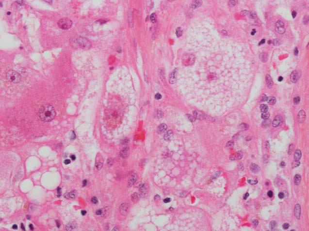 Association of Steatosis with Necrosis