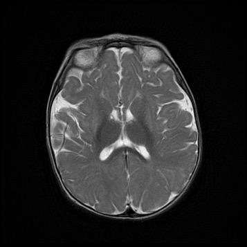 Results: 2 Patients with Neurological Signs Without Prior Ketoacidotic Events Patient #2: 1-year old At