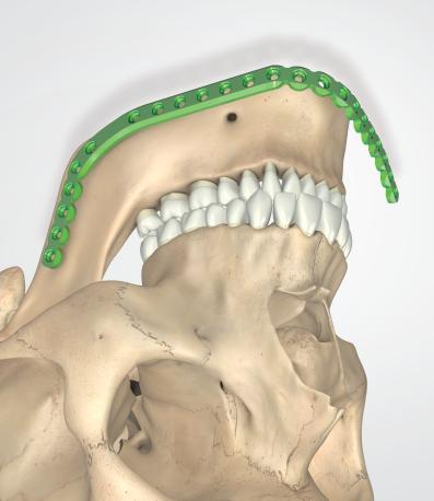 Therefore, only minimal intraoperative adaption may be required to adhere to the surface of the bone and perfectly fit the patient s mandible.