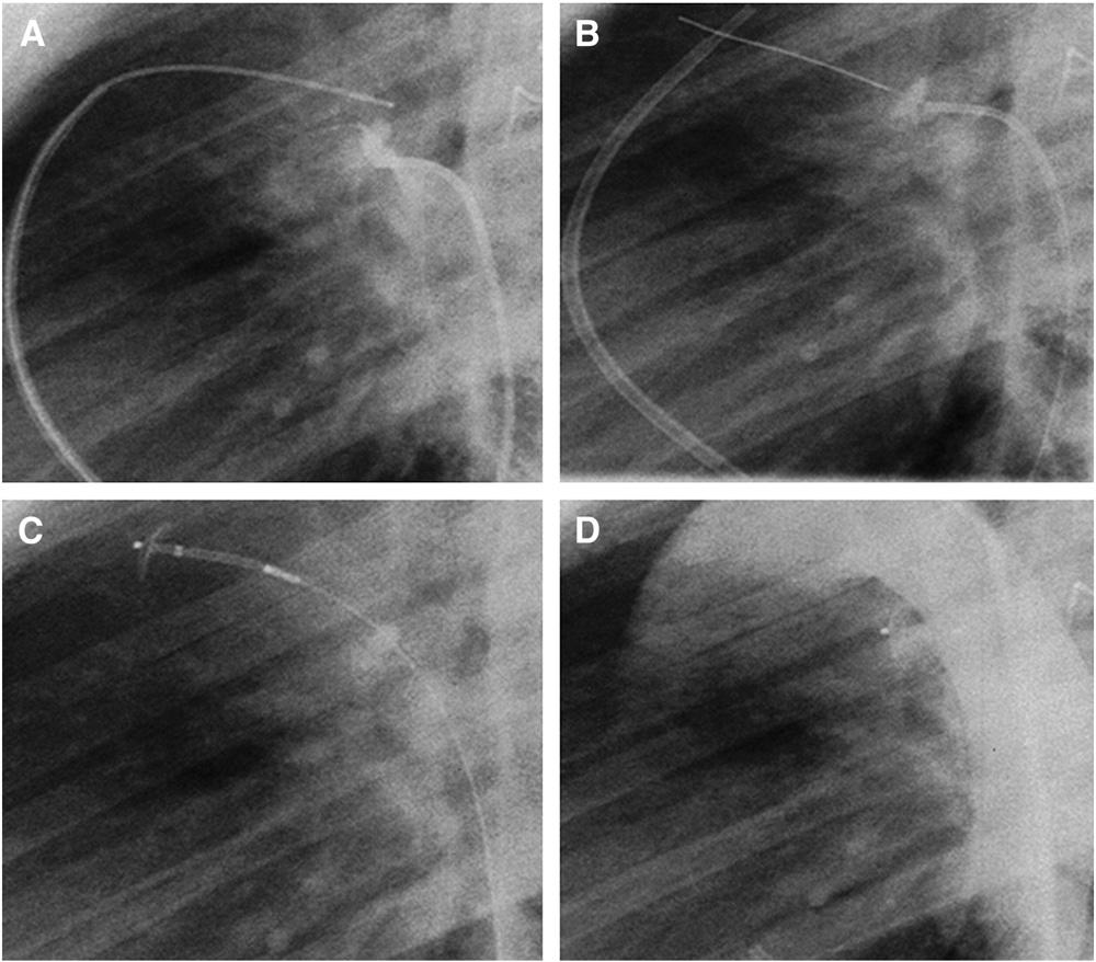 American Heart Journal Volume 156, Number 5 Thanopoulos et al 917.e3 Figure 2 Steps of transcatheter closure using the ADO II in a 4-year-old patient with a type D PDA.