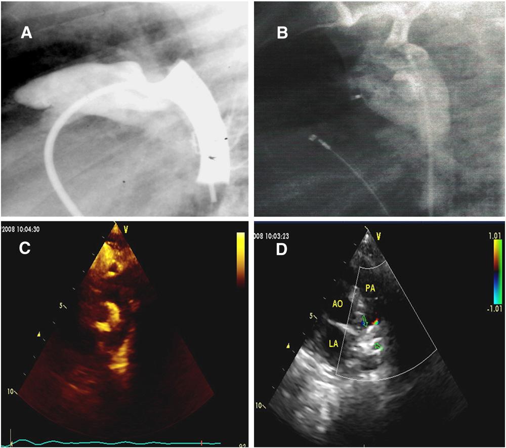 917.e6 Thanopoulos et al American Heart Journal November 2008 Figure 5 Antegrade descending aortogram in the lateral projection (A) obtained from a 3-month-old (body weight 3.5 kg) showing a large, 4.