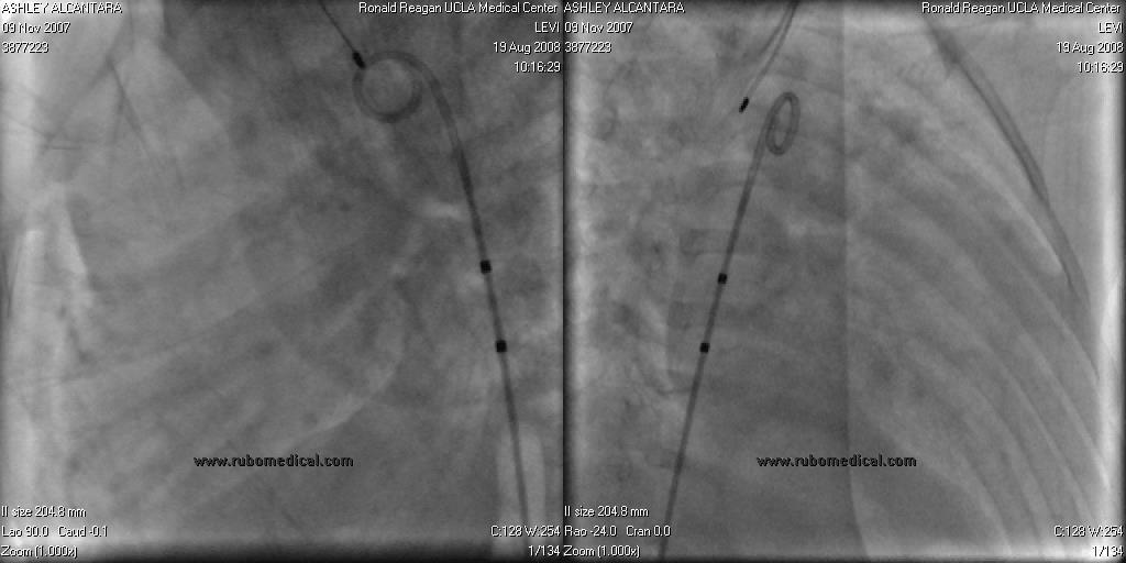 PDA Devices: Angiography Detailed anatomy