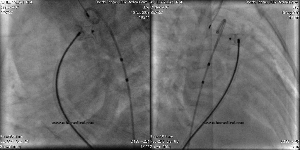 PDA Devices: Angiography Residual shunt PA