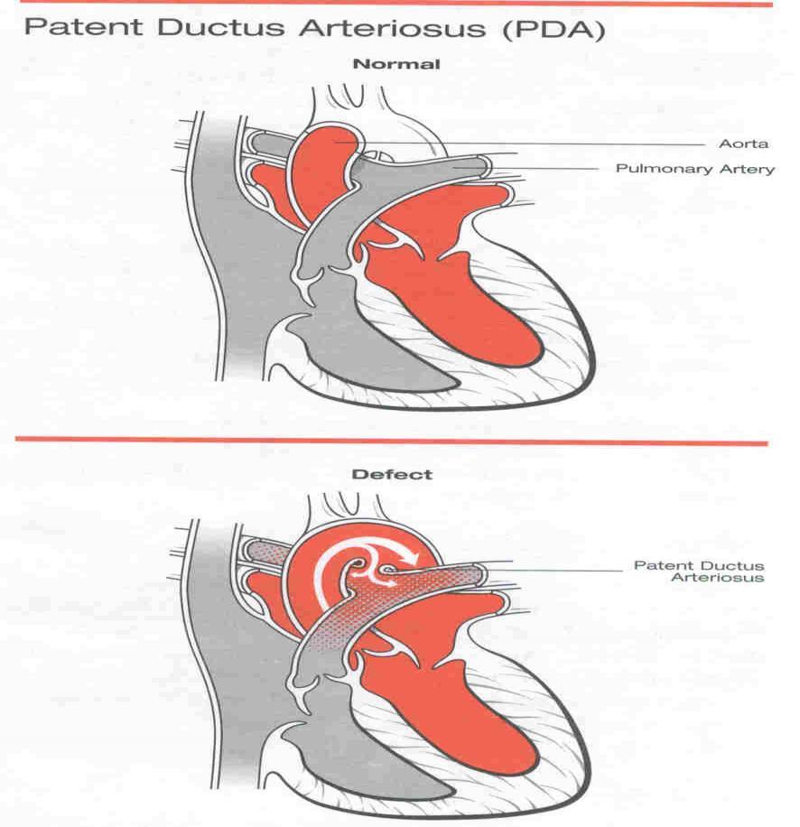PDA: Indications for PDA closure Symptoms Age dependent Premie, timing Left-sided heart enlargement by