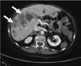 Top, CT scans of a patient with metastatic colorectal cancer harboring an LMNA NTRK1 rearrangement were recorded at baseline (March 2014), at the time of partial response to the pan-trk inhibitor