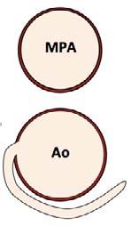 (ALCAPA and ARCAPA) 2. Anomalous course Inter-arterial (anterior) Retro-aortic (posterior) 3.