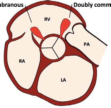 Ventricular Septal Defect Peri-membranous Doubly committed AVSD Muscular Doubly committed