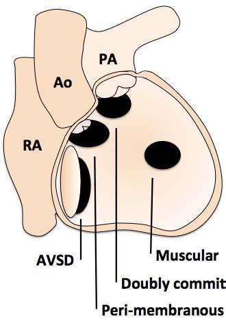 AVSD (shunting at atrial and ventricular levels) Associated findings Peri-membranous VSD: Septal