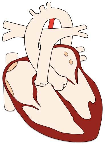 Patent Ductus Arteriosus Pre-operative findings PDA LA and LV dilation LV dysfunction