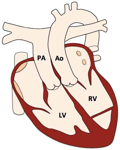 Congenitally Corrected Transposition of the Great Arteries Pre-operative findings L-TGA: AV and VA discordance Systemic RV Parallel great