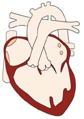 Single Ventricle Physiology
