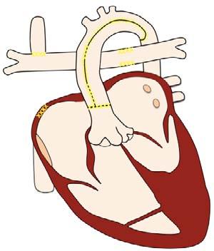 to ascao anastomosis to supply coronary circulation BT shunt or RV to PA shunt to supply PAs Atrial