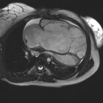 Ebstein Anomaly Severe displacement of the septal tricuspid leaflet
