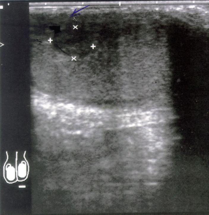 FIGURE 1. Ultrasound image showing hypoechoic lesion in the upper pole of the left testis emphasising the difficulty in distinguishing a malignant lesion from testicular infarction.