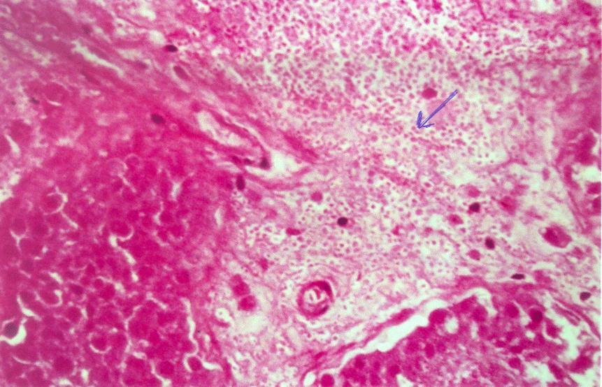 PATHOLOGY The macroscopic appearance of the specimen revealed a loculated hydrocoele. At one pole of the testis, there was a haemorrhagic area surrounded by a yellow rim measuring 8 mm across.
