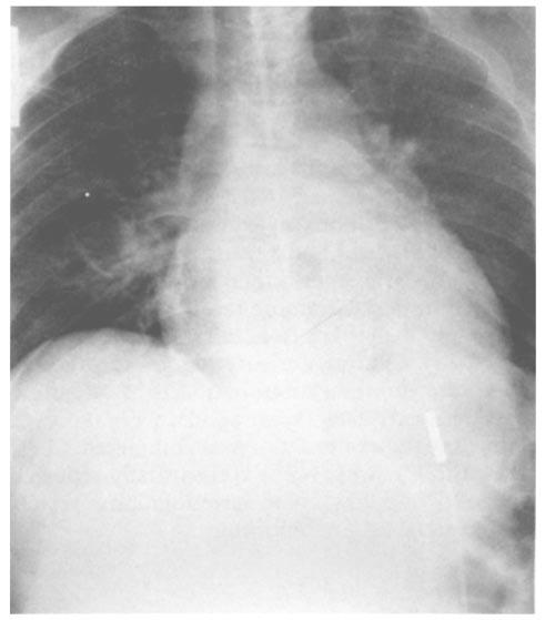 portable chest x-ray film (Figs. 1 and 2). None of the vascular injuries sustained was suspected on the basis of the CT findings.